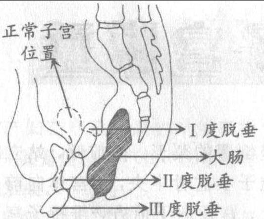 重度子宫脱垂的图片图片